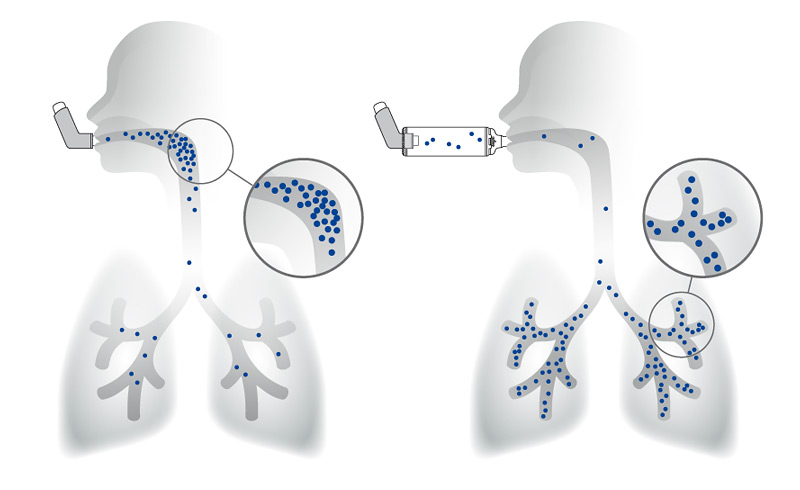 Deposition des Wirkstoffs in der Lunge mit und ohne Inhalierhilfe